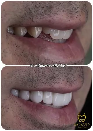 نمونه ای از ایرادات دندان برای انجام لمینت دندان در کرج